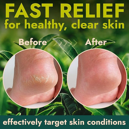 14 Oz Callus Remover Gel+ 3 Free Pumice Stones| Callus Remover For Feet | Tea Tree Professional Grade Foot Exfoliant for Cracked Heels & Dry Feet | Instant Results & Soothing Hydration